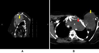Case report and review of literature: Resection of a huge mediastinal low-grade fibromyxoid sarcoma with neck, axillary, and lung involvement